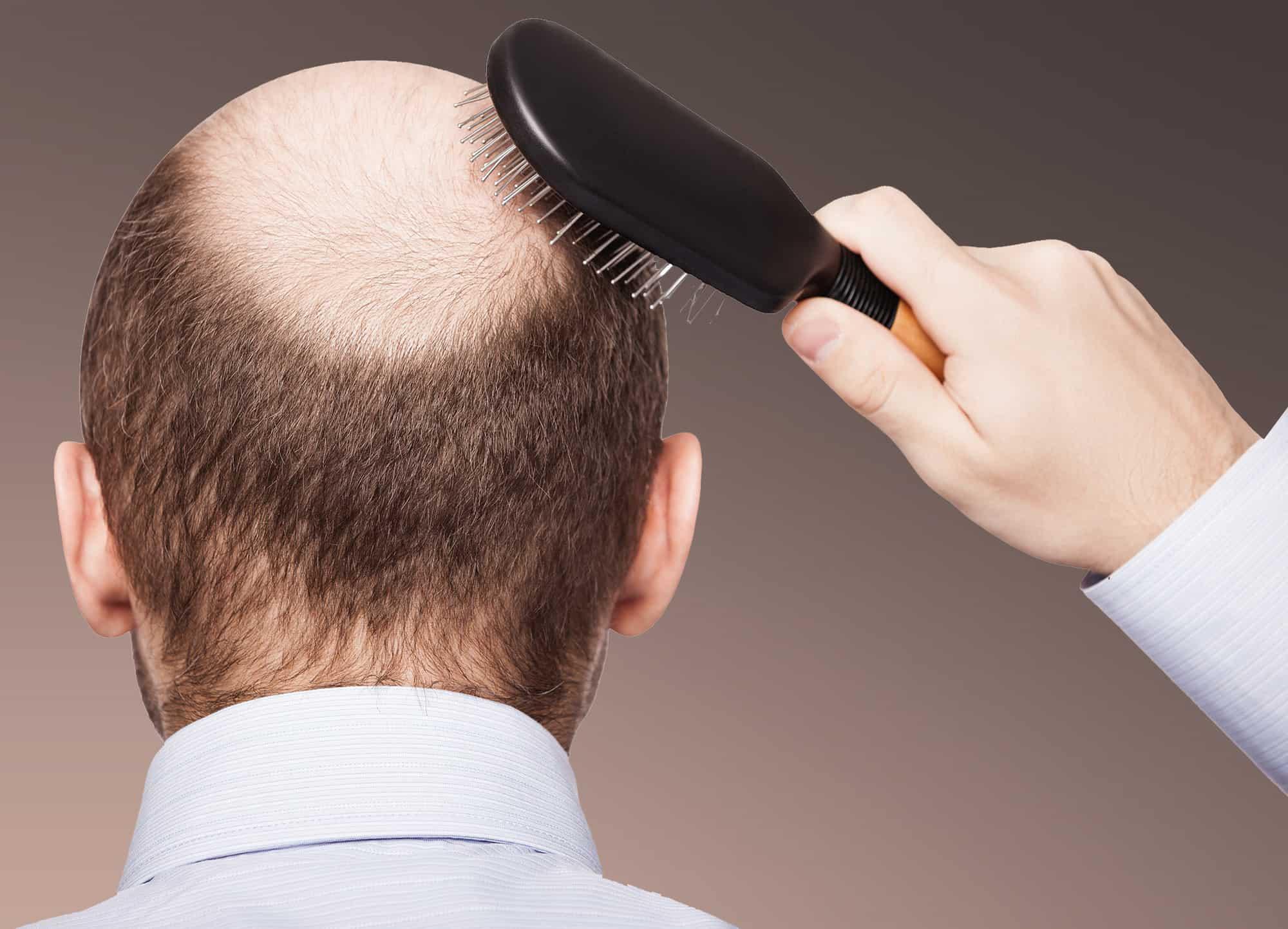 تكلفة زراعة الشعر