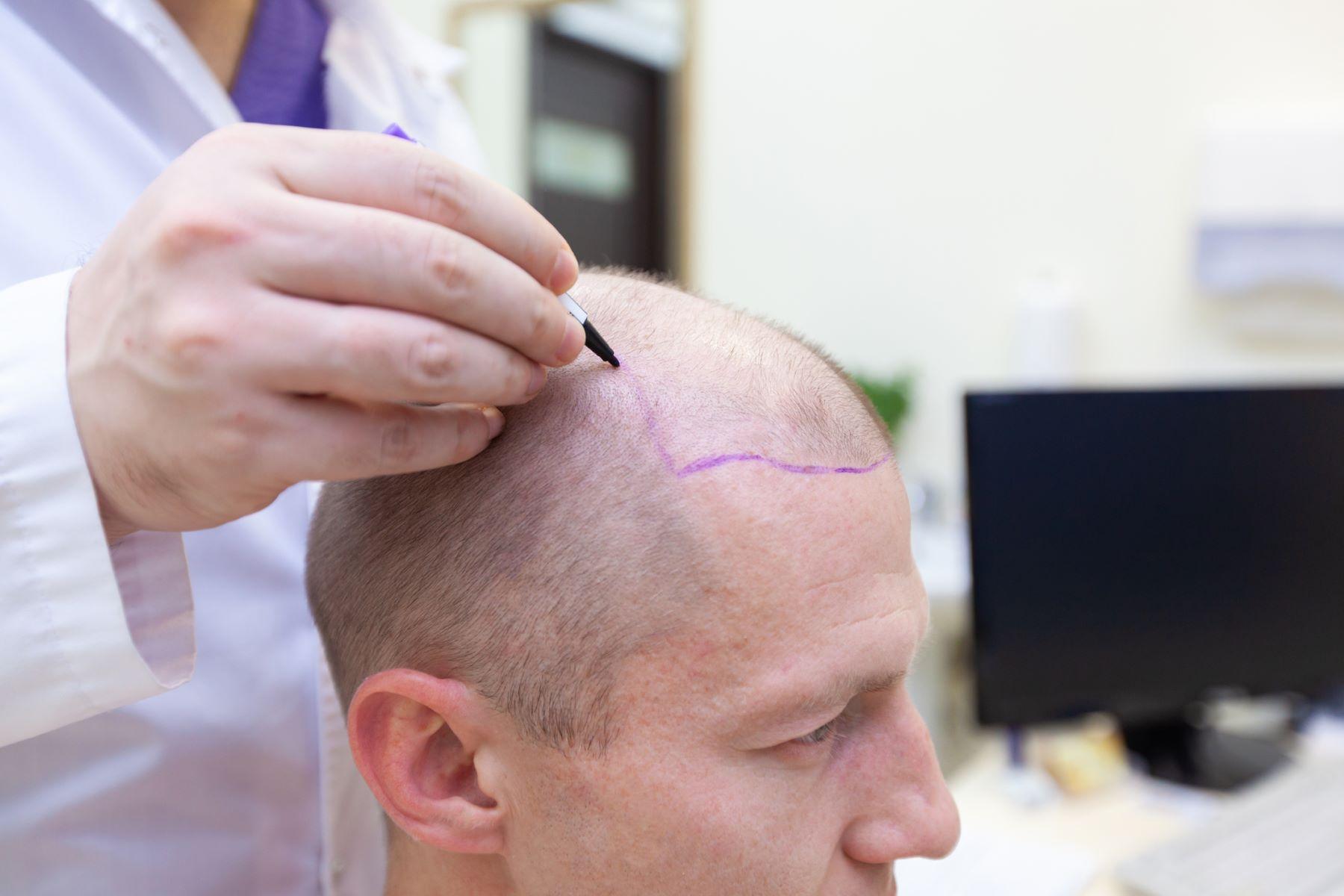 تكلفة زراعة الشعر