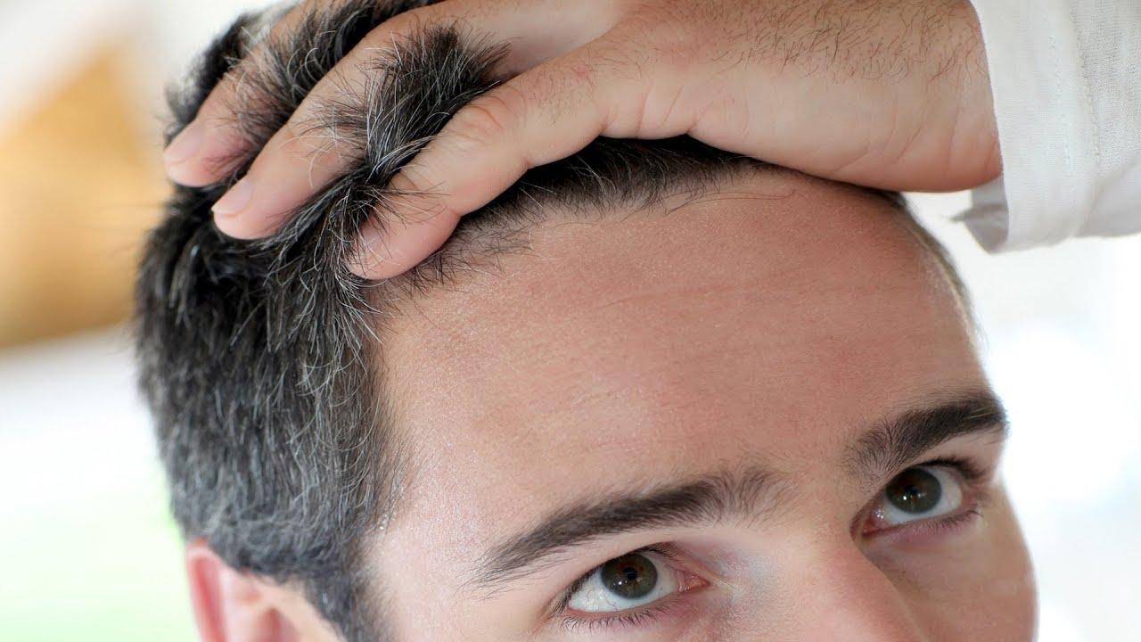 زراعة الشعر في دبي