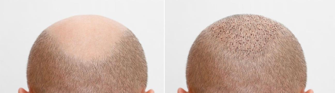 Cosmo Hair Transplant Clinic